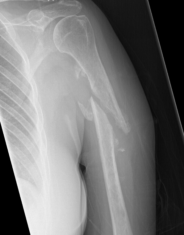 Humerus shaft nonunion